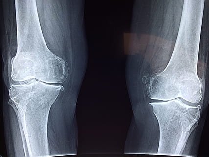 Hd Wallpaper X Ray Result Fracture Bone Xray Skeleton Diagnosis