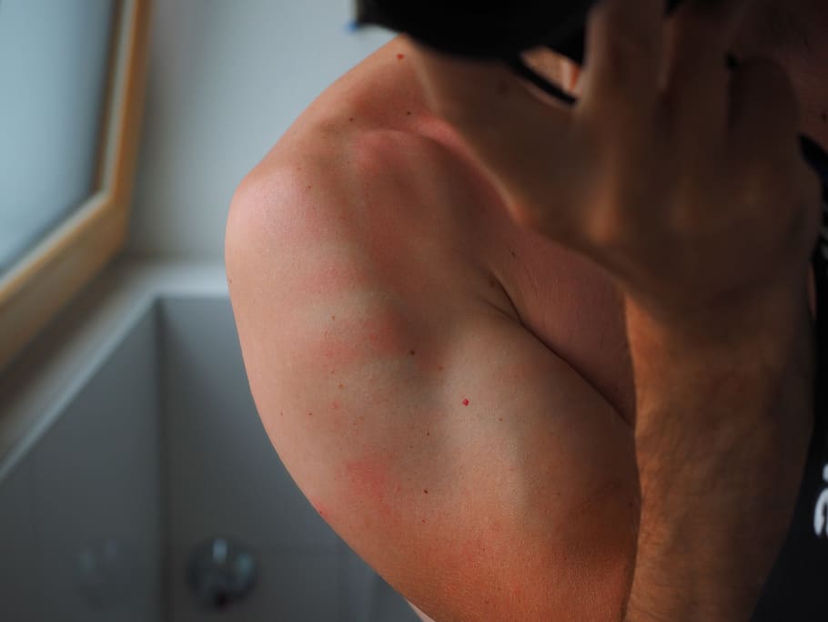 person's right hand, Sunburn, Skin, Flushed, Dermatology, red, HD wallpaper
