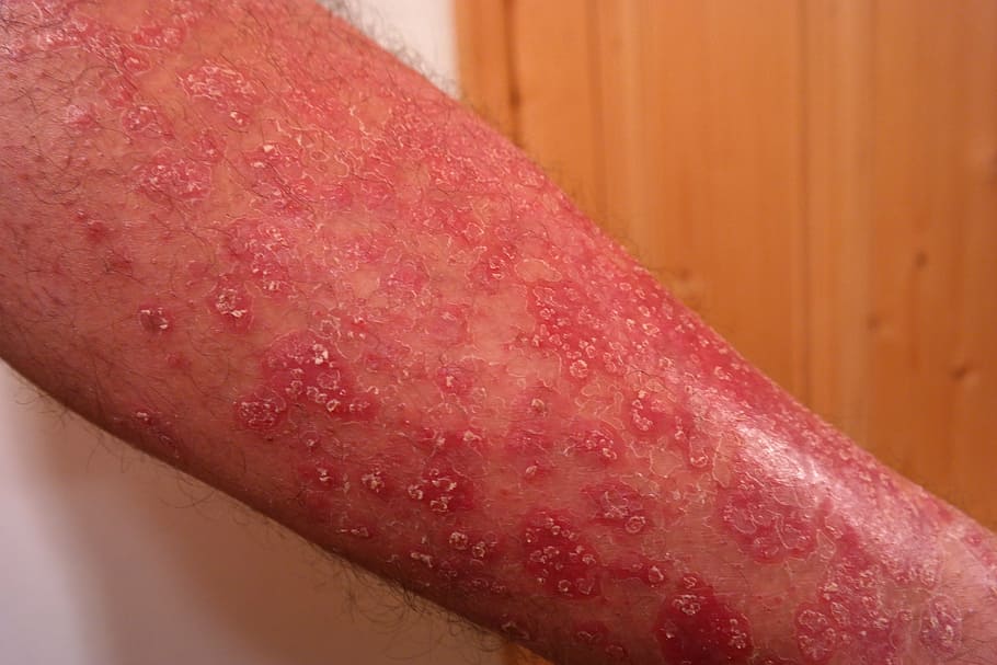 human skin condition, psoriasis, heutkrankheit, red, scaly, inflammatory skin disease
