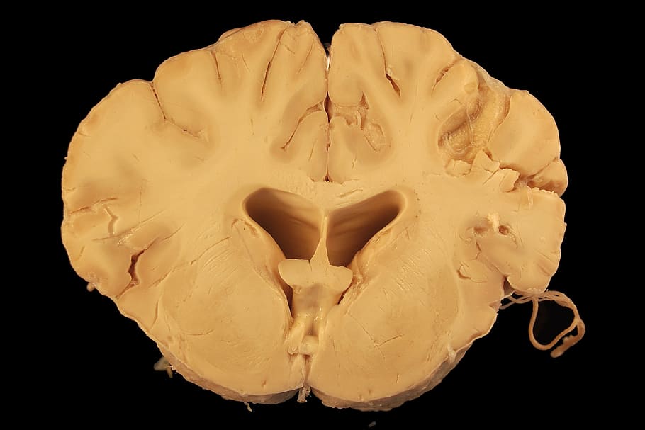 slice huma brain decor, anatomy, dog, cerebrum, ventricle, white matter