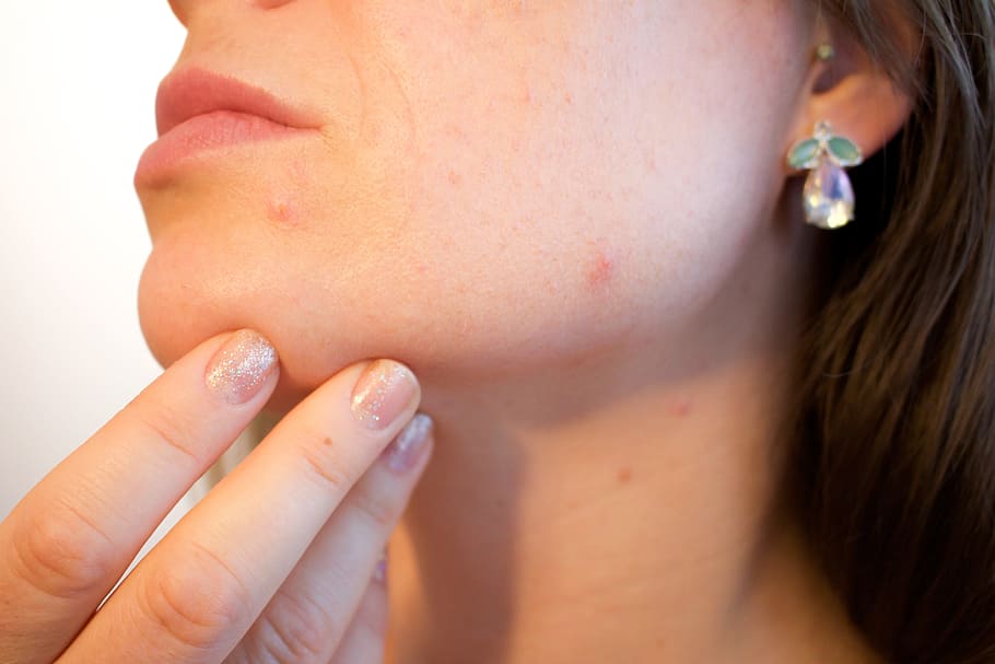 woman wearing silver earrings, human, skin condition, acne, pores, HD wallpaper
