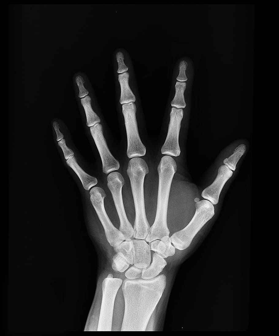 hand x-ray, health, arm, doctors, medicine, bone, hospital, medical insurance, HD wallpaper