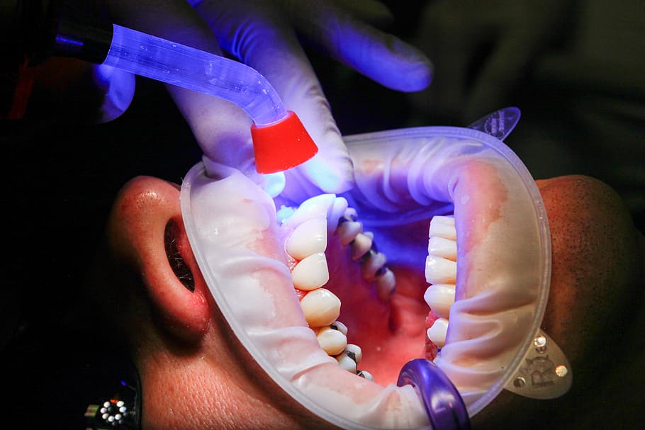 person having dental session, dentist, facet, uv light, curing
