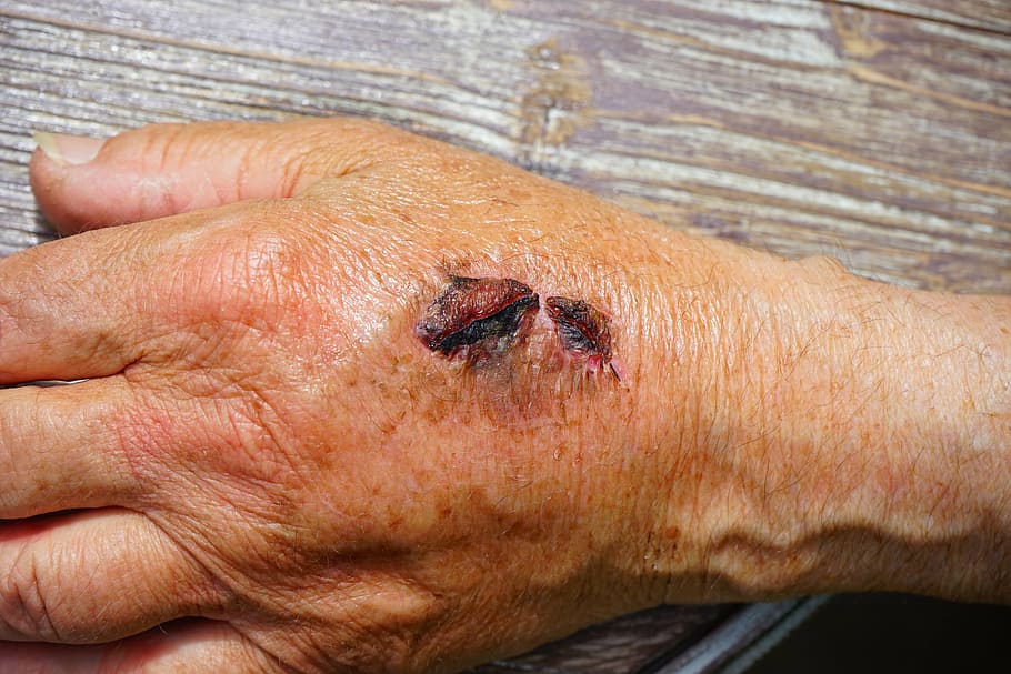 human skin condition, hand, injury, skin abrasion, gall, bloody, HD wallpaper