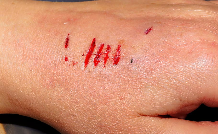 HD wallpaper: human skin condition, hand, injury, bite, dog bite, painful,  blood | Wallpaper Flare