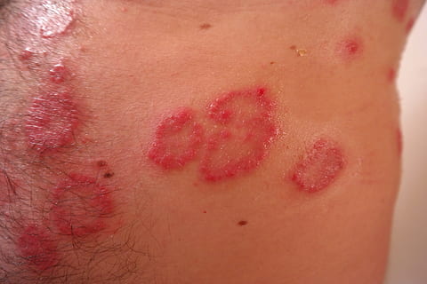 human skin condition, Rash, Inflamed, Reddish, Psoriasis, heutkrankheit HD wallpaper