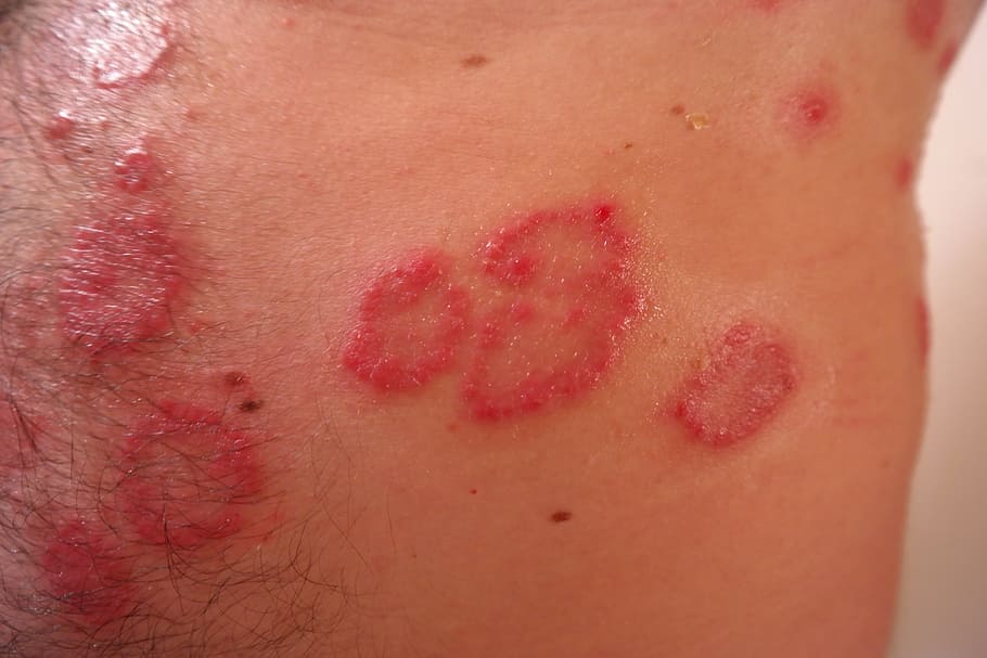 HD bakgrunnsbilde: menneskelig hudtilstand, Utslett, Betent, Rødlig