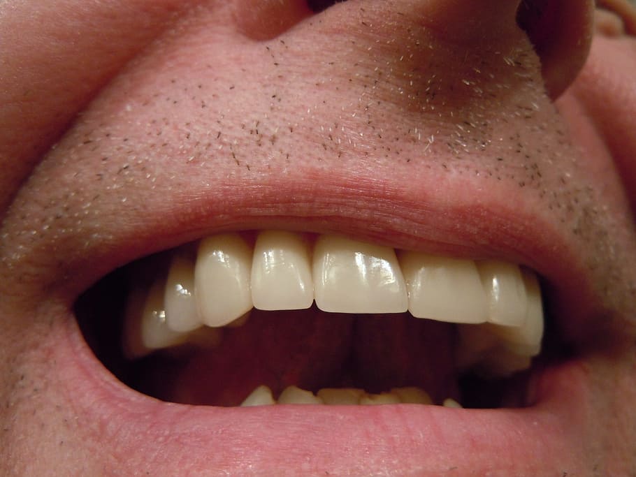 person's teeth, dental, tooth, mouth, lips, crowns, caps, ceramic, HD wallpaper