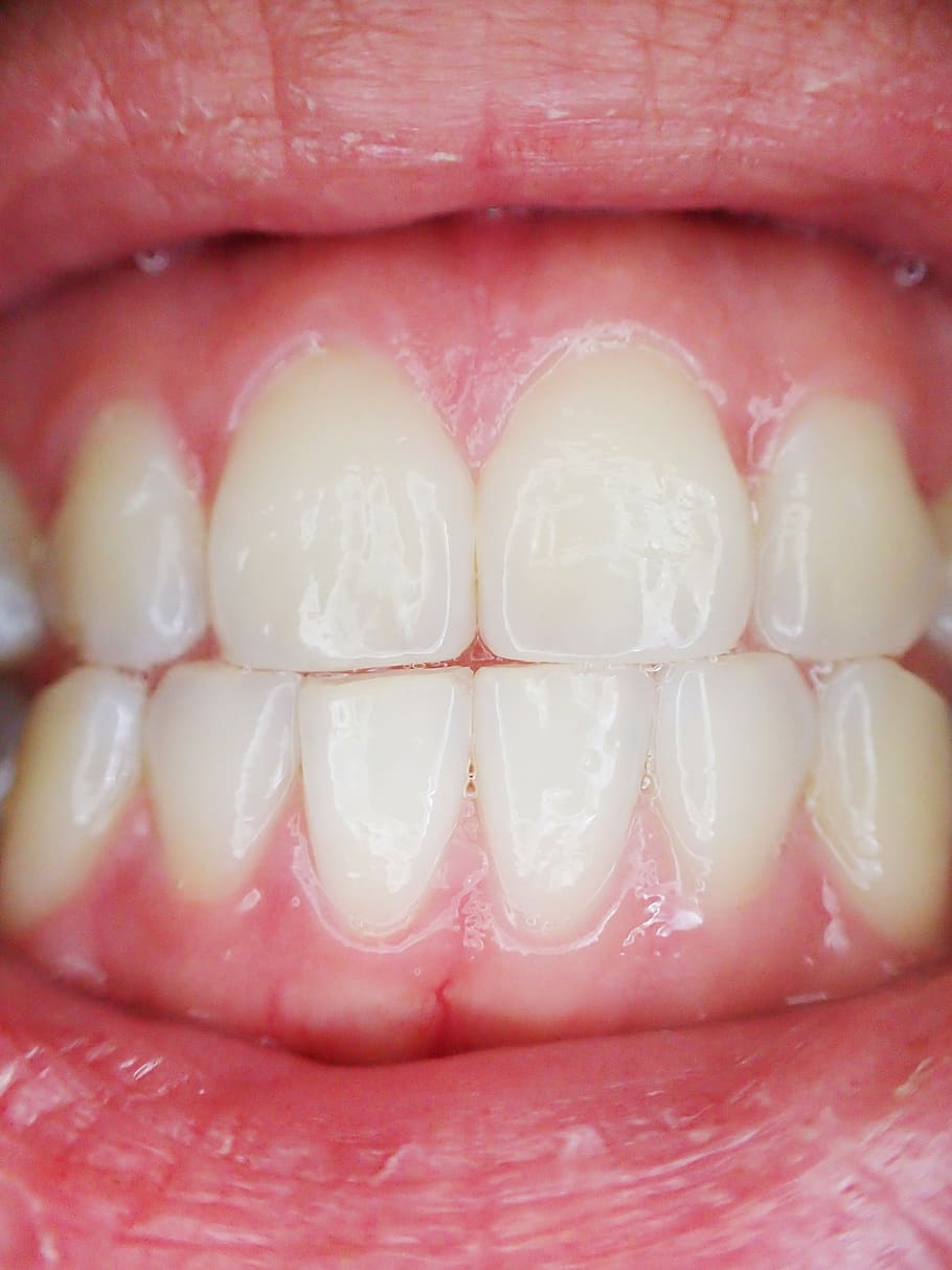 closeup photo of person's teeth, mouth, dental, dentist, tooth