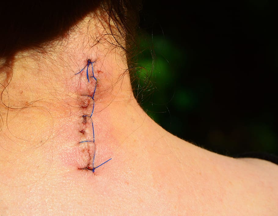 person with stitched nape, discogenic operational, wound, seam