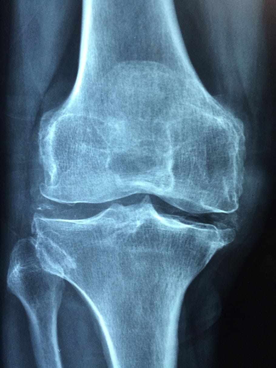 X-ray results on bone, knee, old, care, injury, pain, knee pain