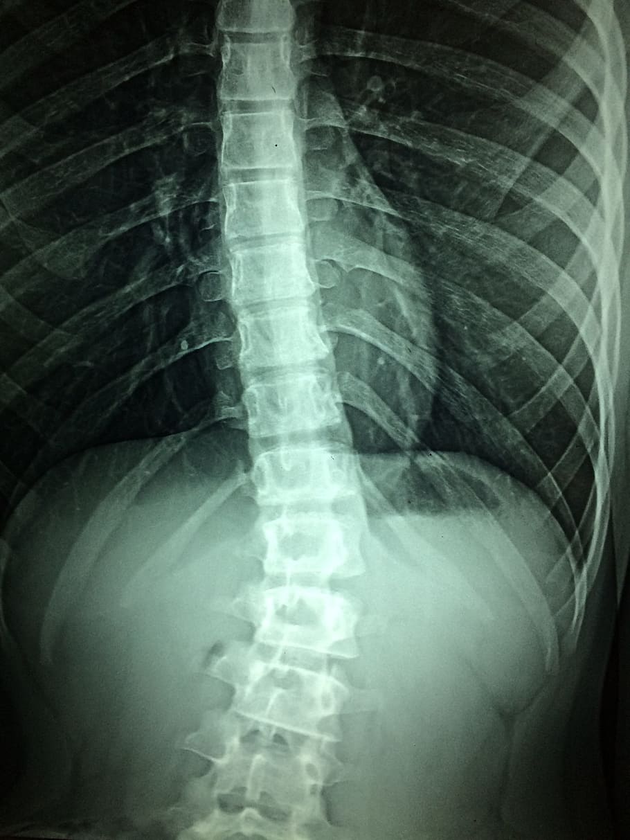radiograph result, X-Rays, Hospital, Disability, doctor, patient