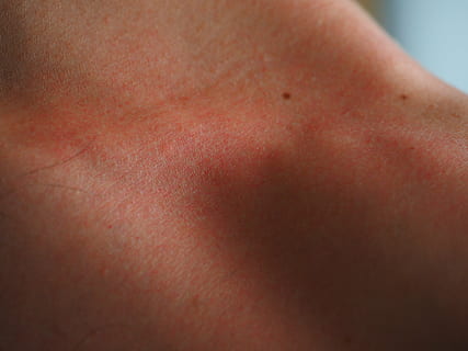 human skin condition, sunburn, red, flushed, dermatology, burned HD wallpaper