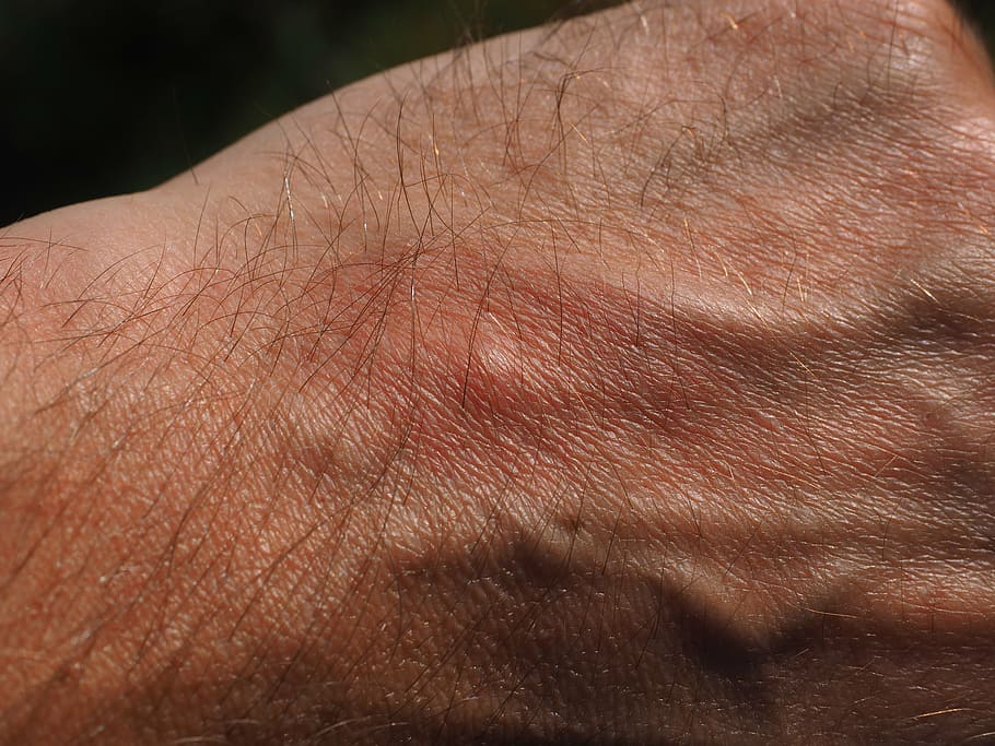 person's fist, mosquito bite, engraving, itching, allergy, pustules HD wallpaper