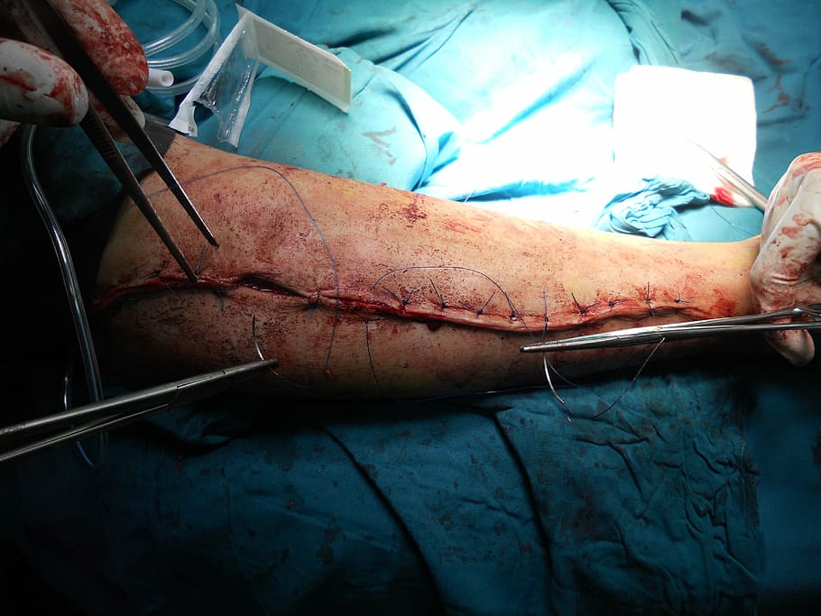 person having a arm surgery, orthopedic, hospital, doctor, healthcare