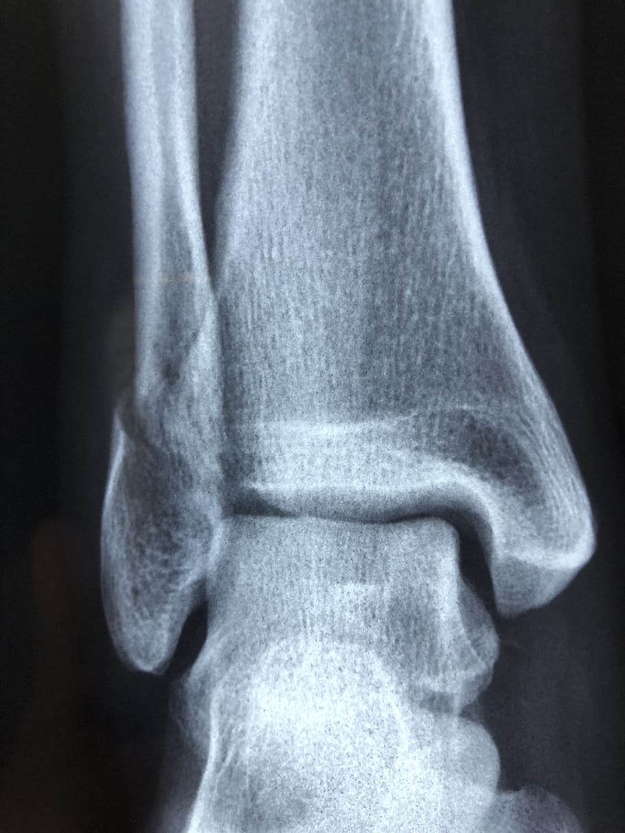 bone x-ray result, radiography, diagnosis, anatomy, injury, radiology