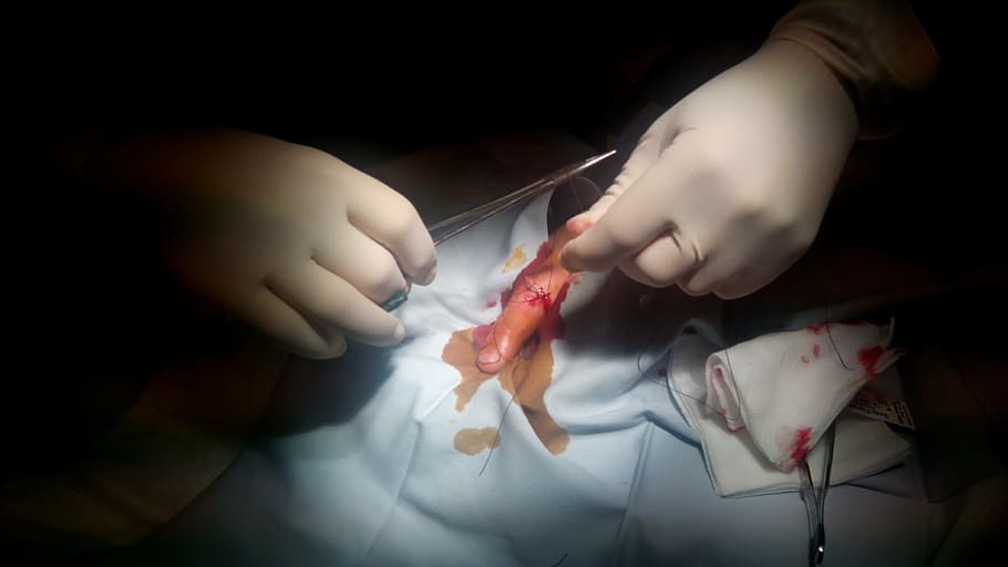 suture, wound, finger, hand, medicine, surgery, human hand HD wallpaper
