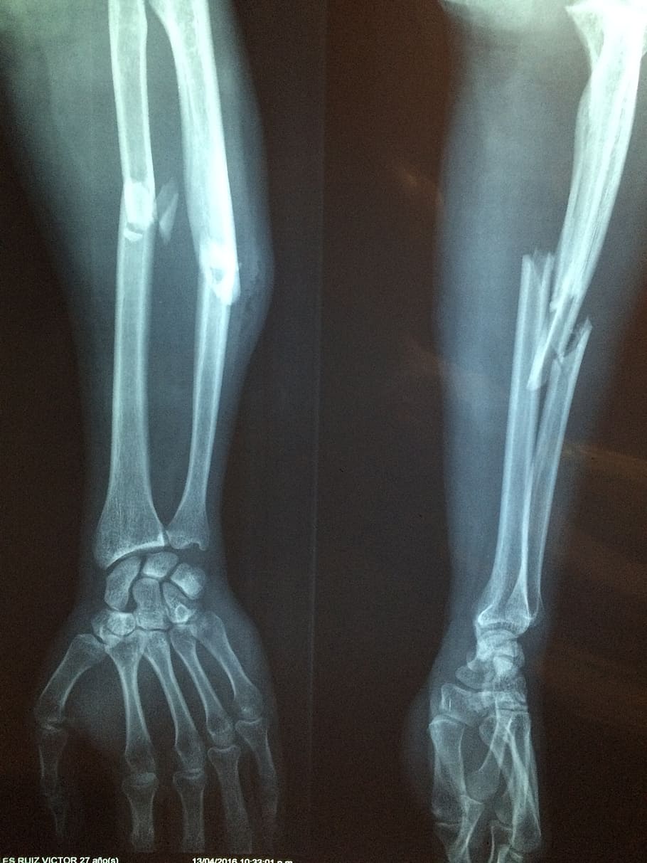 x-ray result, fracture bone, xray, skeleton, diagnosis, broken, HD wallpaper