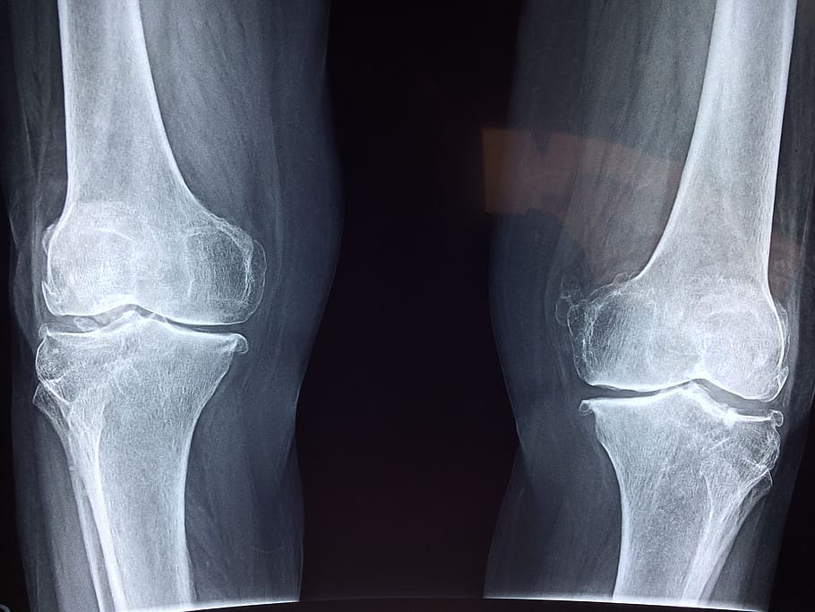 photo of human leg knees x-ray results, medical, anatomy, skeleton, HD wallpaper
