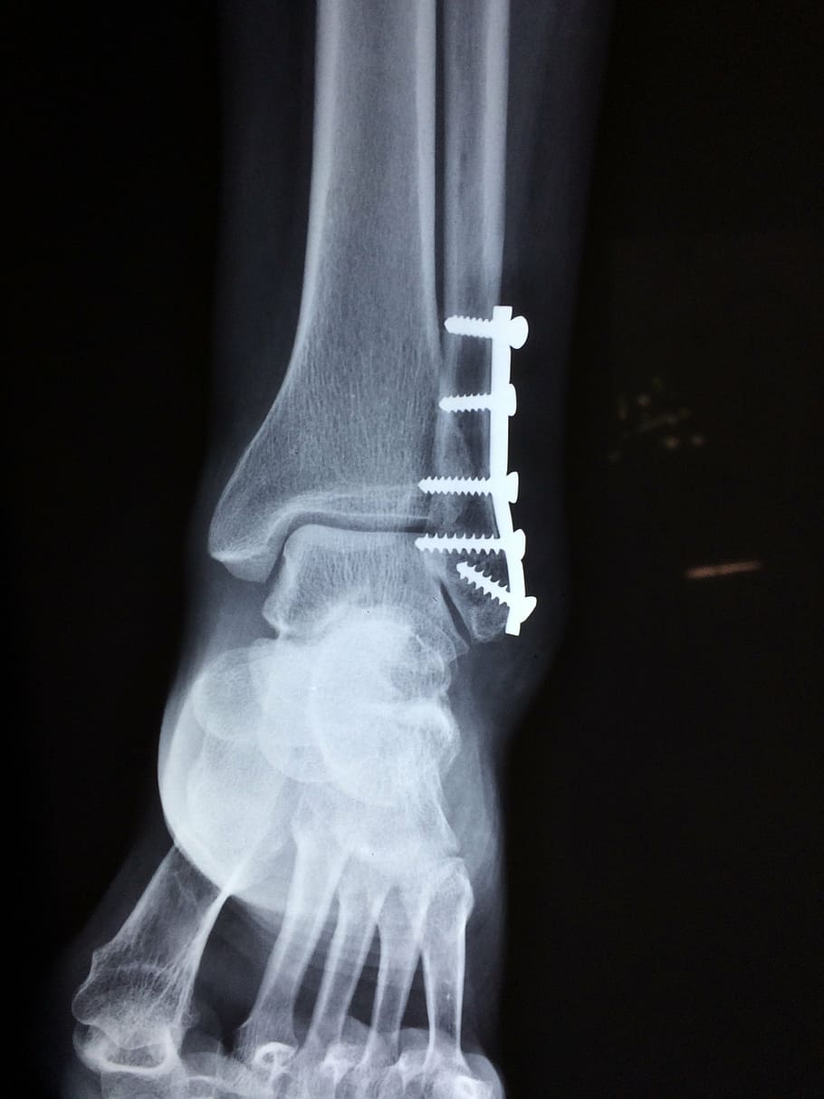 bone ultrasound result, ankle, fracture, foot, medical, accident