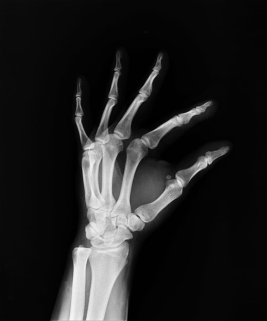 hand X-ray, health, arm, doctors, medicine, bone, hospital, medical insurance, HD wallpaper