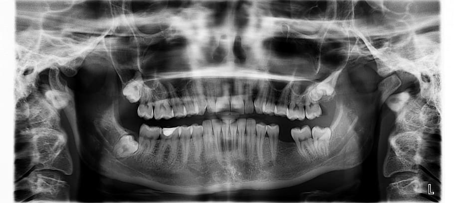 x-ray result, x ray, teeth, tooth missing, human body part HD wallpaper