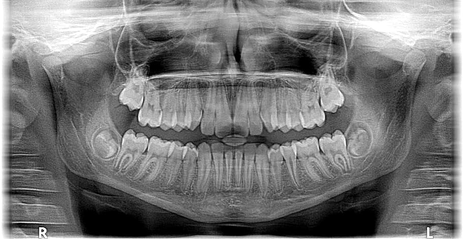 x-ray photo of the human skull, xray x-ray, roentgen, teeth, jaw, HD wallpaper