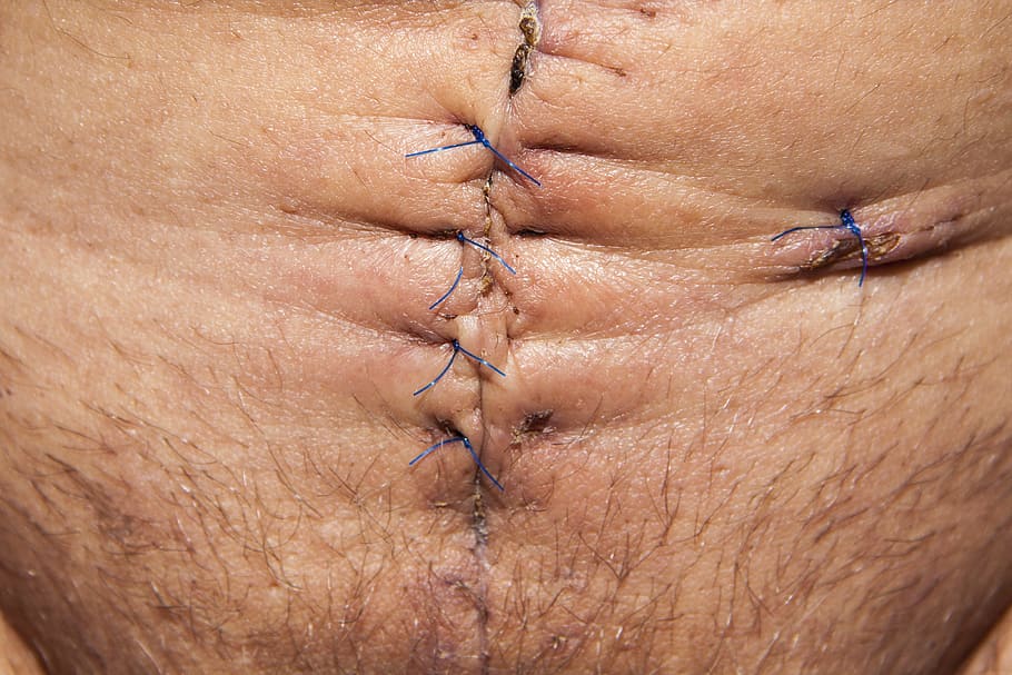 closeup of human's tummy with stitches, op, operation, abdomen surgery