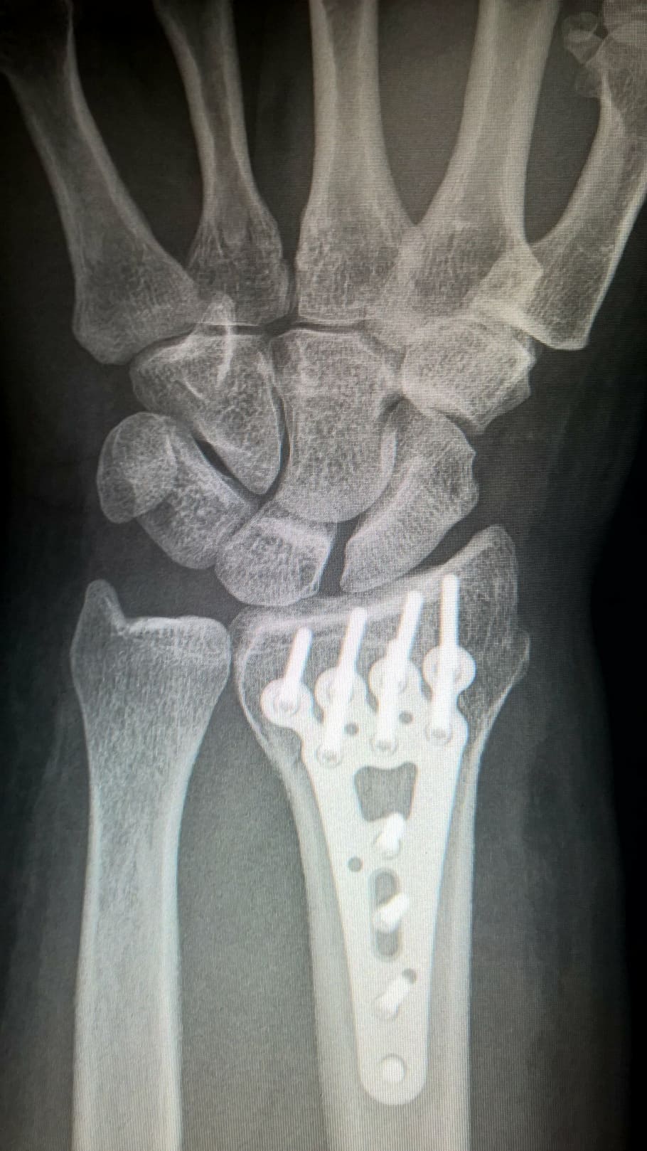x-ray of arm, broken arm, plate fixation, titanium plate, fracture of radius