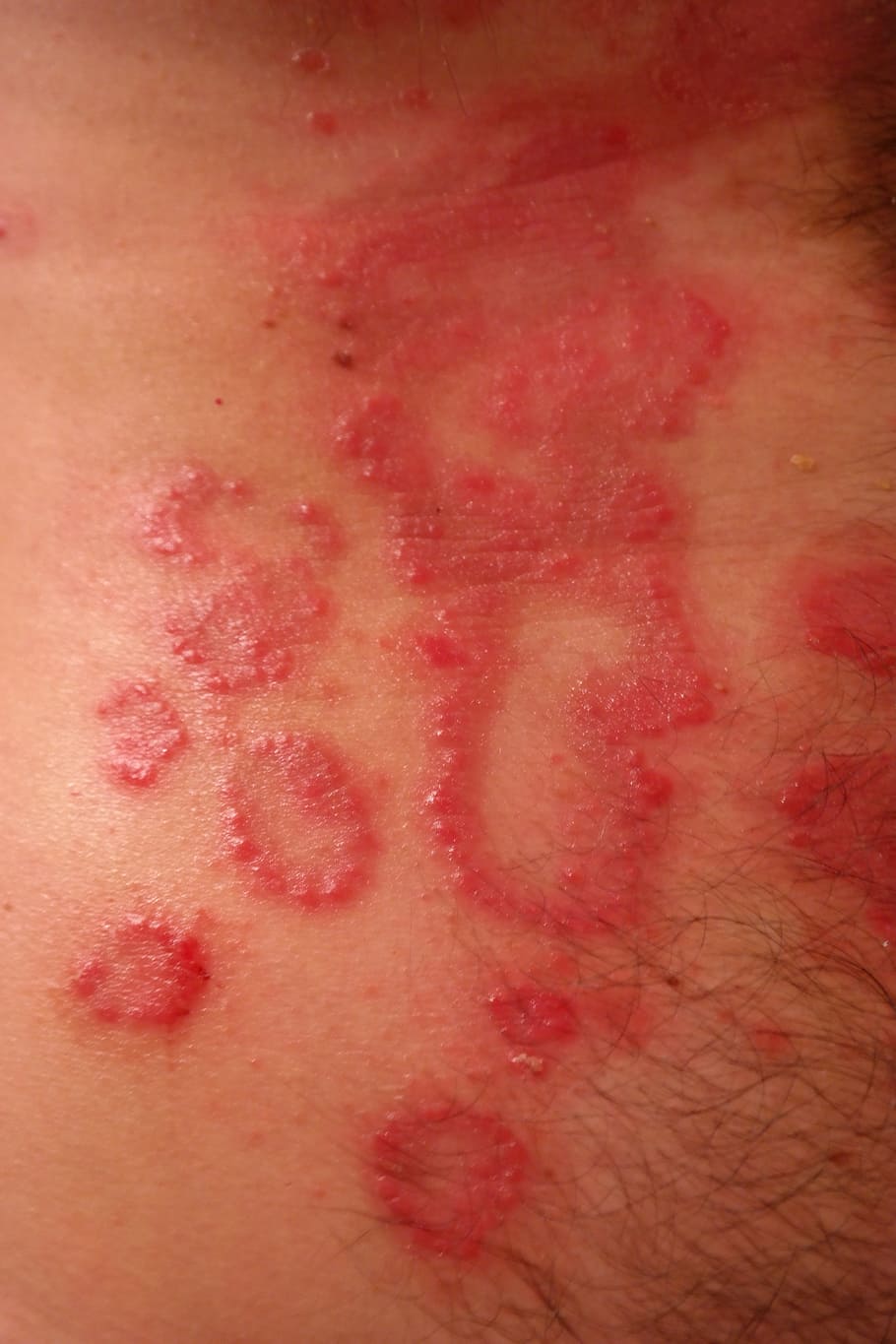 human skin condition, Rash, Inflamed, Reddish, Psoriasis, heutkrankheit HD wallpaper